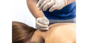Acupunctura